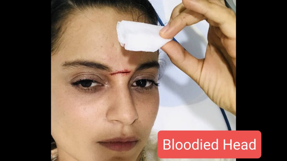 OMG: Kangana Ranaut shares picture of injured bloodied head