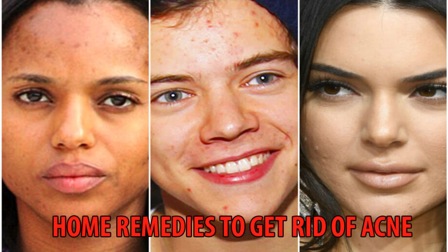 Facing Acne Problems? Check These 3 Home Remedies Which Will Help You Fight Against Acne And Have A Smooth Glowing Skin