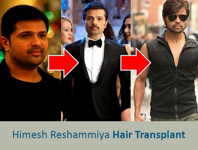Check out Himesh Reshammiya's untold hair transplant story | IWMBuzz