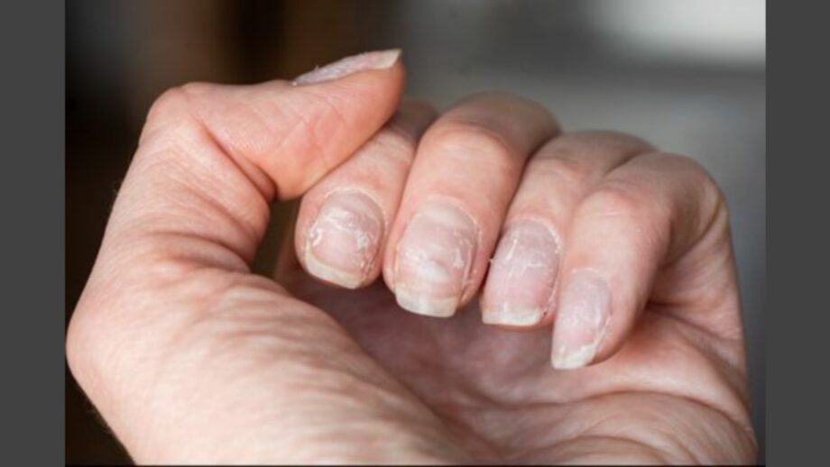 Suffering From Brittle Nails? View Out These Remedies! | IWMBuzz