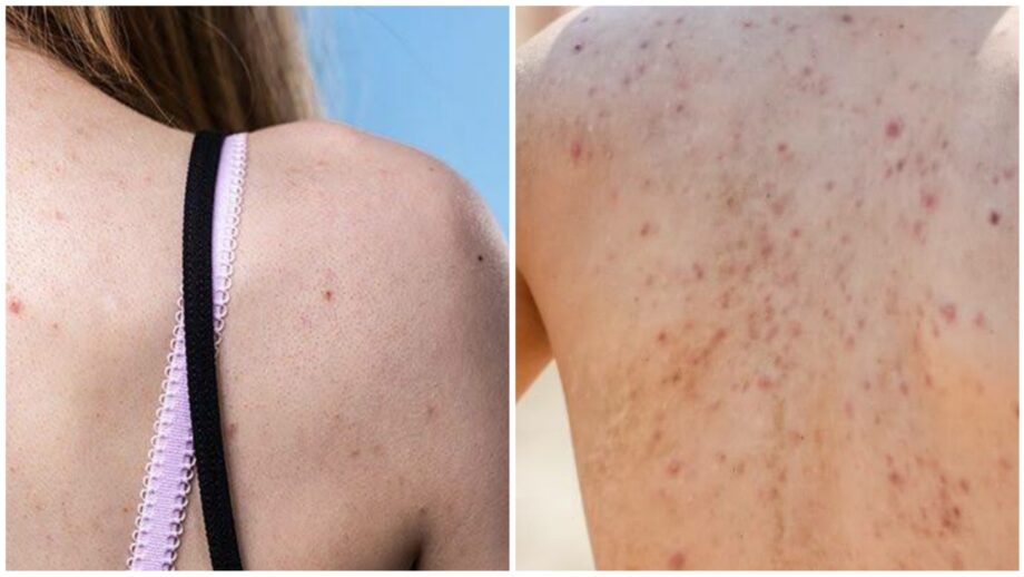 Tips And Tricks! Here’s How You Can Prevent And Get Rid Of Back Acne 498054