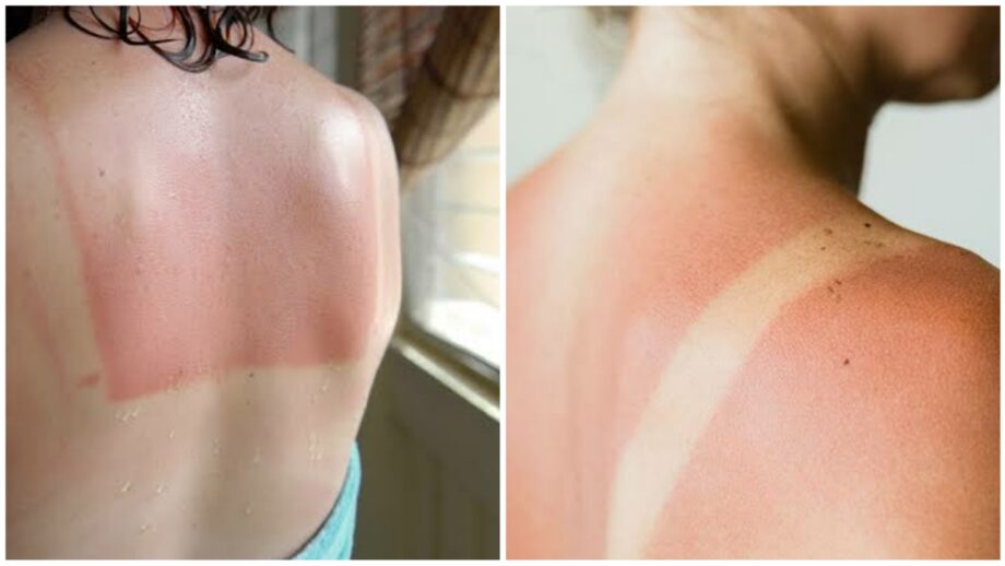 Worried About Tanning & Sunburns? Check Out How To Avoid It 497787