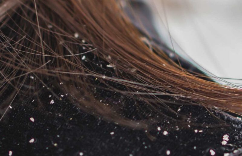 Get rid of itchy scalp and dandruff with these simple tips