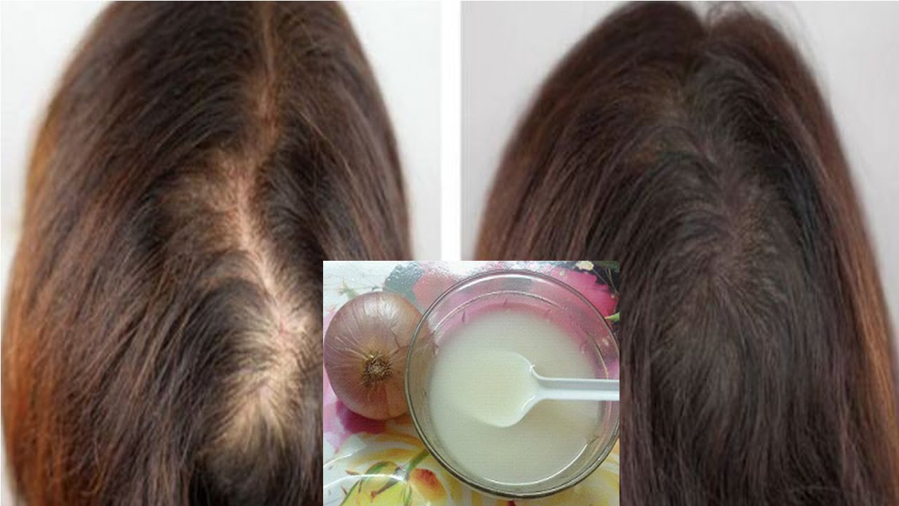How Does Onion Help With Hair? Read | IWMBuzz