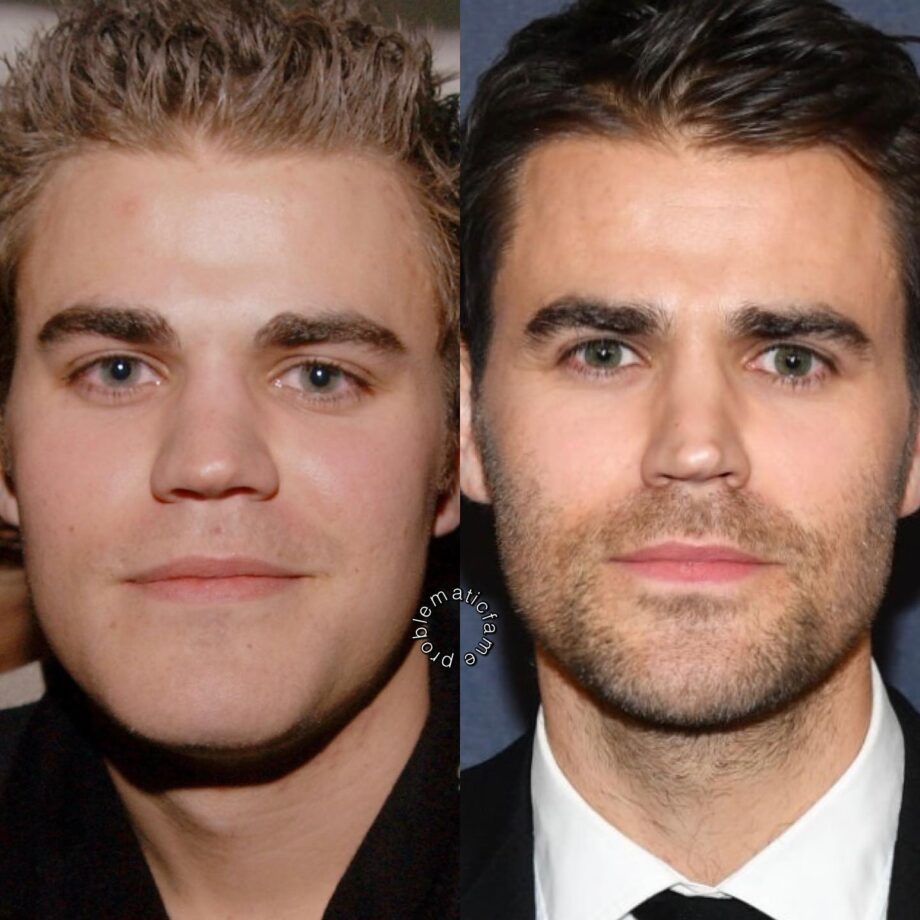 Unknown Male Celebrities Who Underwent Plastic Surgery 763210