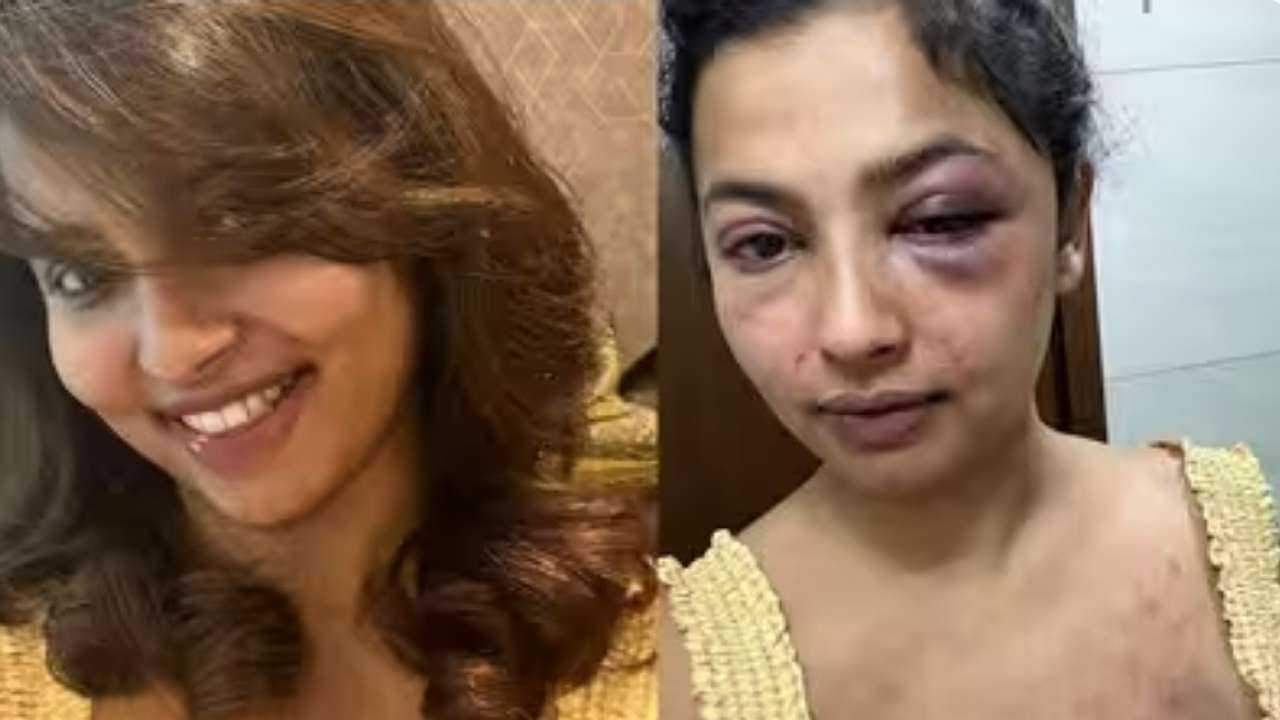 Malayalam actor Anicka Vikhraman accused ex-boyfriend of abuse, see shocking snaps of bruises 781410