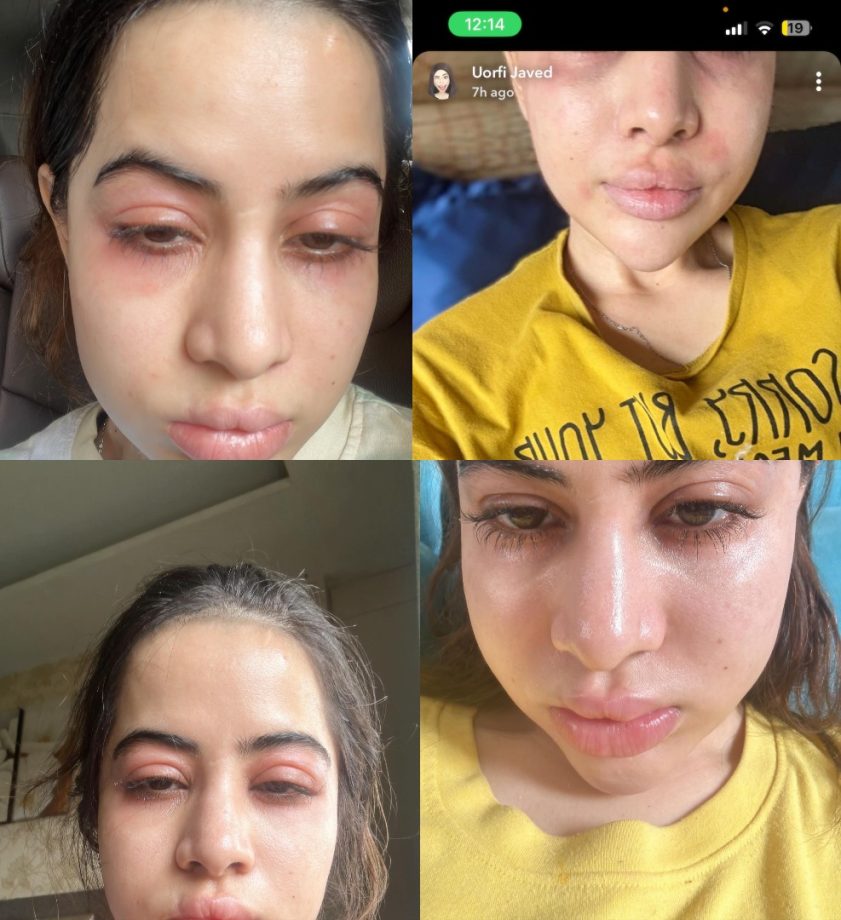 “Fillers Nahi Hai, Allergies Hai! Urfi Javed Opens Up About Swollen Face On Instagram 898234