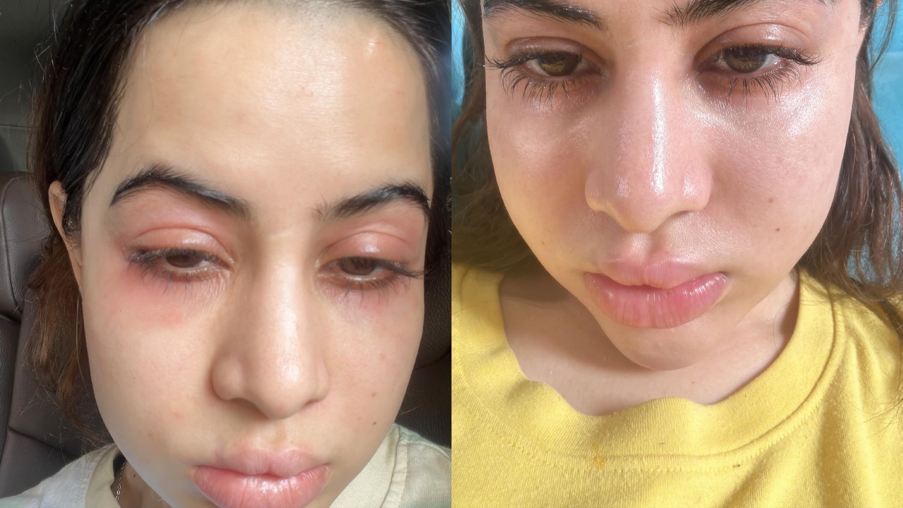 “Fillers Nahi Hai, Allergies Hai! Urfi Javed Opens Up About Swollen Face On Instagram 898232