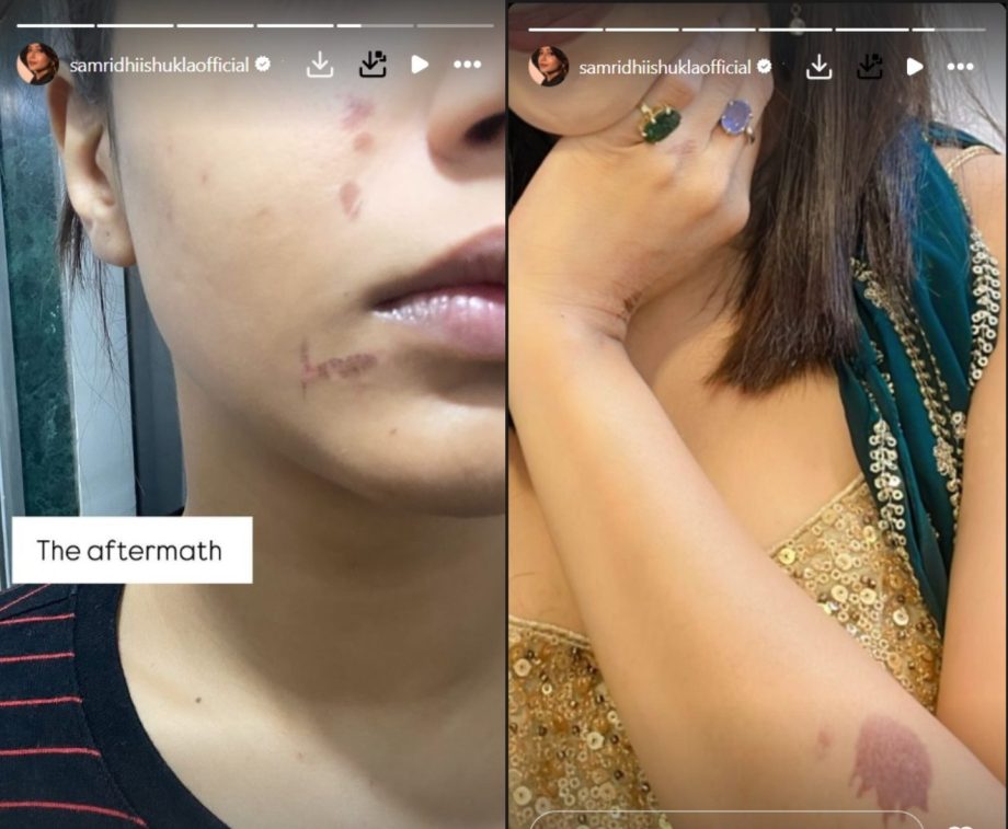 Samriddhi Shukla aka Abhira from 'Yeh Rishta Kya Kehlata Hai' shares worrying images of her burn marks on the face & hand 926194
