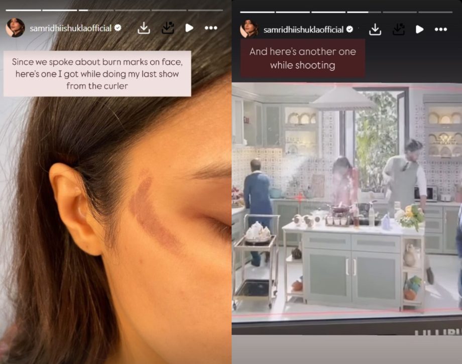 Samriddhi Shukla aka Abhira from 'Yeh Rishta Kya Kehlata Hai' shares worrying images of her burn marks on the face & hand 926195