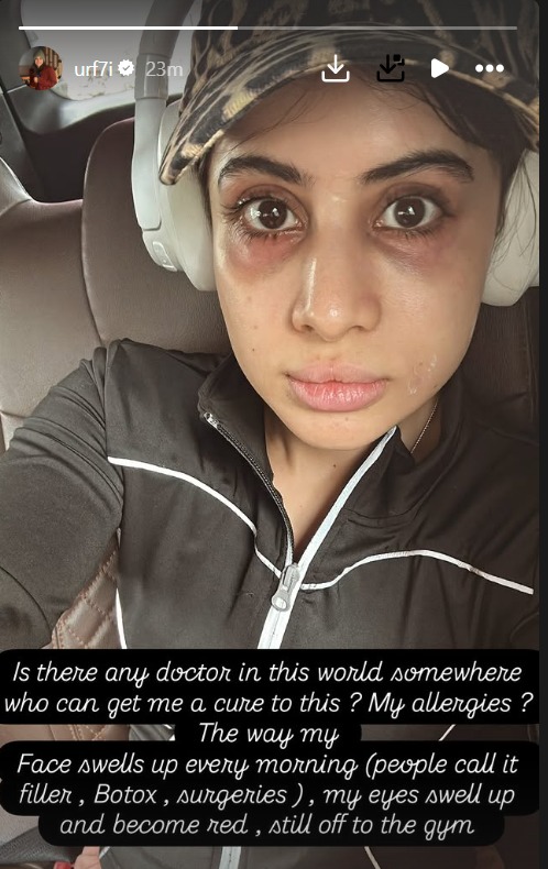 Uorfi Javed’s Swollen Face Sparks Concern: “Is There Any Doctor Who Can Cure This?” 957605